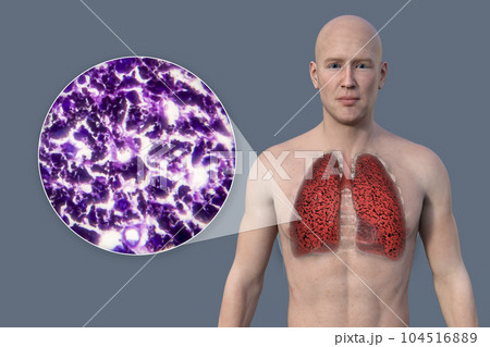 A 3D illustration of the upper half part of a man with transparent skin, revealing the condition of smoker's lungs 104516889