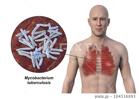 A 3D illustration showcasing the upper half part of a man with transparent skin, revealing the lungs affected by miliary tuberculosis 104516893
