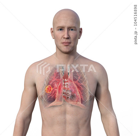 A 3D illustration of the upper half part of a man with transparent skin, revealing a lung mucormycosis lesion A 3D illustration of the upper half part of a man with transparent skin, revealing a lung mucormycosis lesion 104516898