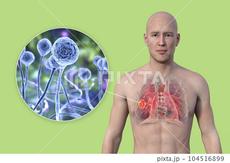 A 3D illustration of the upper half part of a man with transparent skin, revealing a lung mucormycosis lesion, with close-up view of Mucor fungi 104516899