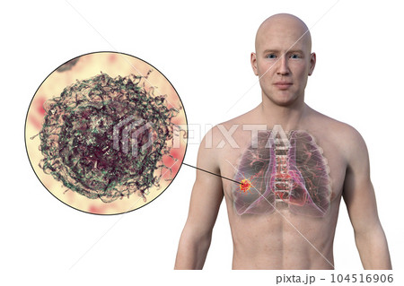 A 3D illustration of the upper half part of a man with transparent skin, revealing the presence of lung cancer 104516906