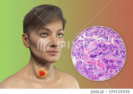 A 3D scientific illustration showcasing a woman with transparent skin, revealing a tumor in her thyroid gland, along with a micrograph image of thyroid cancer. A 3D scientific illustration showcasing a woman with transparent skin, revealing a tumor in her thyroid gland, along with a micrograph image of thyroid cancer. 104516936