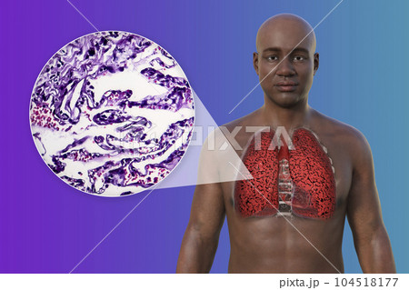 A 3D illustration of the upper half part of an African man with transparent skin, revealing the condition of smoker's lungs A 3D illustration of the upper half part of an African man with transparent skin, revealing the condition of smoker's lungs 104518177