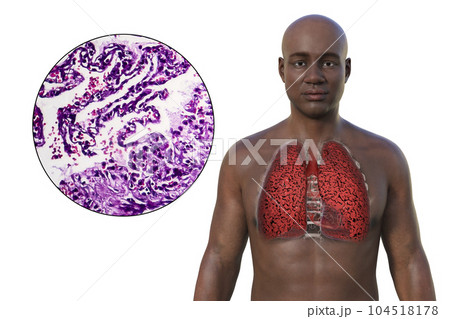A 3D illustration of the upper half part of an African man with transparent skin, revealing the condition of smoker's lungs 104518178
