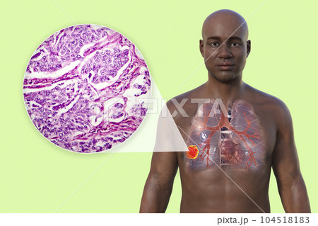A 3D illustration of the upper half part of an African man with transparent skin, revealing the presence of lung cancer 104518183