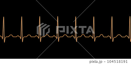 Electrocardiogram ECG displaying sinus tachycardia, 3D illustration Electrocardiogram ECG displaying sinus tachycardia, 3D illustration 104518191
