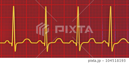 Electrocardiogram ECG displaying sinus tachycardia, 3D illustration 104518193