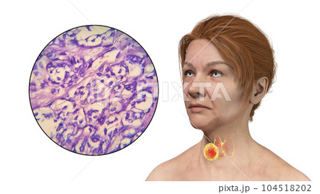 A 3D scientific illustration showcasing a woman with transparent skin, revealing a tumor in her thyroid gland, along with a micrograph image of thyroid cancer. A 3D scientific illustration showcasing a woman with transparent skin, revealing a tumor in her thyroid gland, along with a micrograph image of thyroid cancer. 104518202