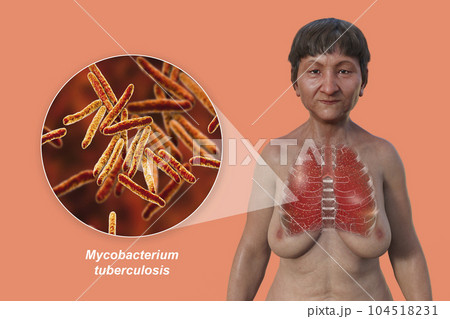 A 3D illustration of a woman with transparent skin, showcasing the lungs affected by miliary tuberculosis and close-up view of Mycobacterium tuberculosis bacteria 104518231