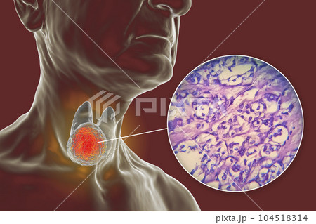 A 3D scientific illustration showcasing a human body with transparent skin, revealing a tumor in his thyroid gland, along with a micrograph image of thyroid cancer. 104518314