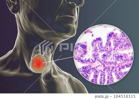 A 3D scientific illustration showcasing a human body with transparent skin, revealing a tumor in his thyroid gland, along with a micrograph image of thyroid cancer. 104518315