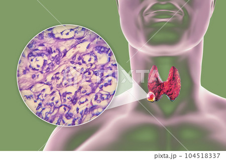 A 3D scientific illustration showcasing a human body with transparent skin, revealing a tumor in his thyroid gland, along with a micrograph image of thyroid cancer. A 3D scientific illustration showcasing a human body with transparent skin, revealing a tumor in his thyroid gland, along with a micrograph image of thyroid cancer. 104518337