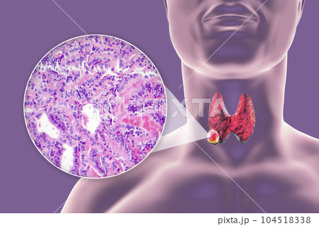 A 3D scientific illustration showcasing a human body with transparent skin, revealing a tumor in his thyroid gland, along with a micrograph image of thyroid cancer. A 3D scientific illustration showcasing a human body with transparent skin, revealing a tumor in his thyroid gland, along with a micrograph image of thyroid cancer. 104518338