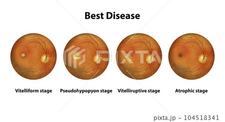 Best vitelliform macular dystrophy stages,...のイラスト素材 [104518341] - PIXTA