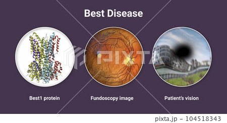 Best disease. Best vitelliform macular dystrophy, illustration Best disease. Best vitelliform macular dystrophy, illustration 104518343