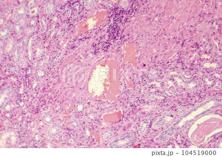 Hyaline degeneration of renal artery Hyaline degeneration of renal artery 104519000