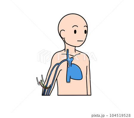 PICCカテーテル 104519528