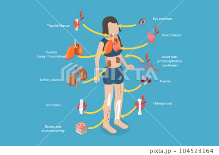 3D Isometric Flat Vector Conceptual Illustration of Lupus Erythematosus 104523164
