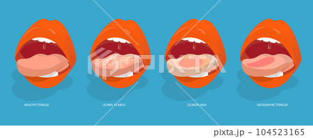 3D Isometric Flat Vector Conceptual Illustration of Sore Or White Tongue 104523165