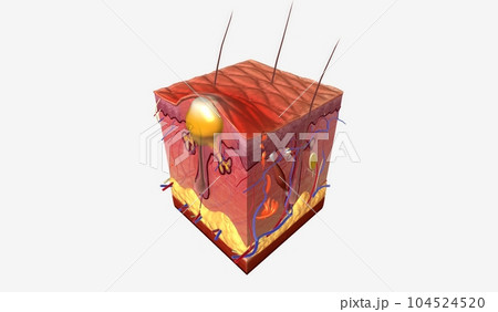 Pustules are a type of acne characterized by large, inflamed bumps with pus filled tips Pustules are a type of acne characterized by large, inflamed bumps with pus filled tips 104524520