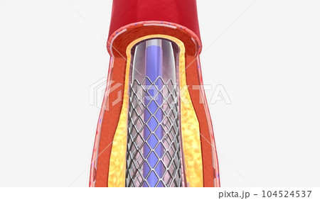 Angioplasty is a minimally invasive procedure that uses a cathet Angioplasty is a minimally invasive procedure that uses a cathet 104524537