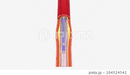 Angioplasty is a minimally invasive procedure that uses a catheter with a balloon tip to expand your blocked artery. 104524542