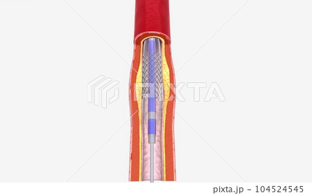 Angioplasty is a minimally invasive procedure that uses a cathet Angioplasty is a minimally invasive procedure that uses a cathet 104524545