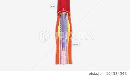 Angioplasty is a minimally invasive procedure that uses a catheter with a balloon tip to expand your blocked artery. 104524548