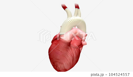The enlarged portion of the aortic arch is replaced with a synthetic graft. The enlarged portion of the aortic arch is replaced with a synthetic graft. 104524557