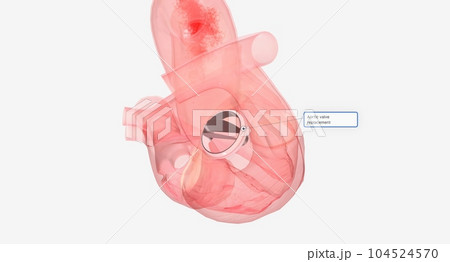 Aortic valve replacement in the heart 104524570