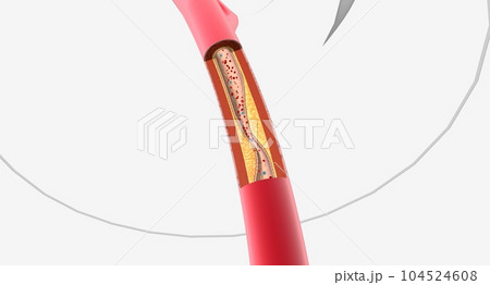 Atherosclerosis is the plaque buildup in the walls of the arteries 104524608