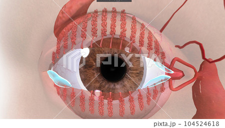 Blepharitis is a chronic inflammation of the eyelids characterized by irritation, redness, watering. Blepharitis is a chronic inflammation of the eyelids characterized by irritation, redness, watering. 104524618