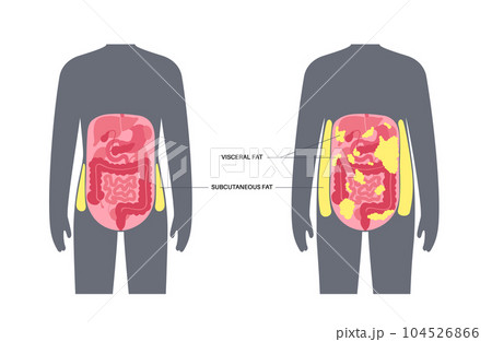 Visceral fat diagram Visceral fat diagram 104526866