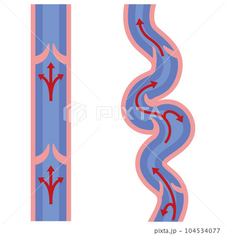 下肢静脈瘤　血管の病気　医療 104534077