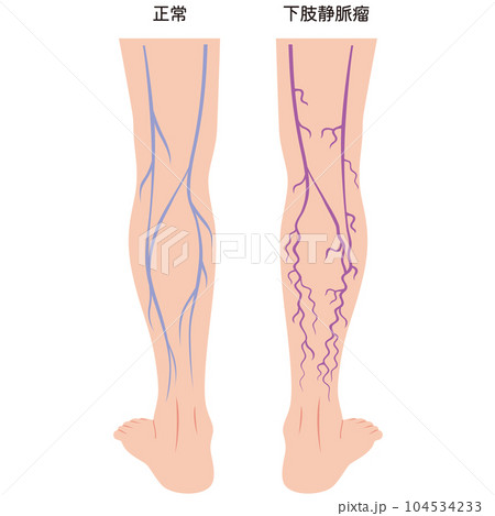 下肢静脈瘤 血管の病気 医療 下肢静脈瘤 血管の病気 医療 104534233