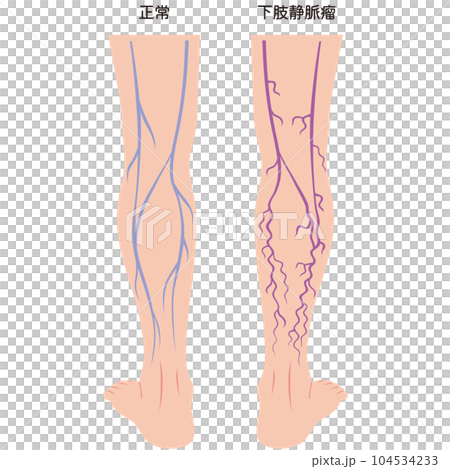 下肢静脈瘤 血管の病気 医療 下肢静脈瘤 血管の病気 医療 104534233
