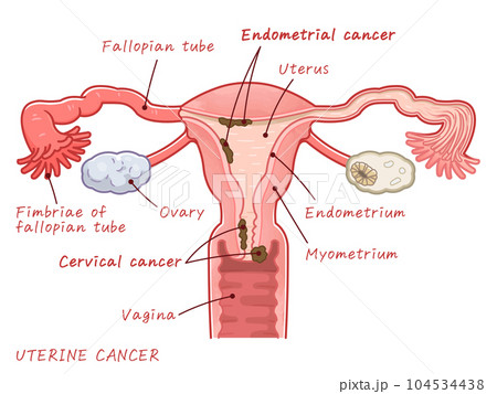 Uterine cancer、Endometrial cancer、Cervical cancer 104534438