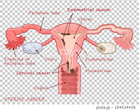 Uterine cancer、Endometrial cancer、Cervical cancer 104534438