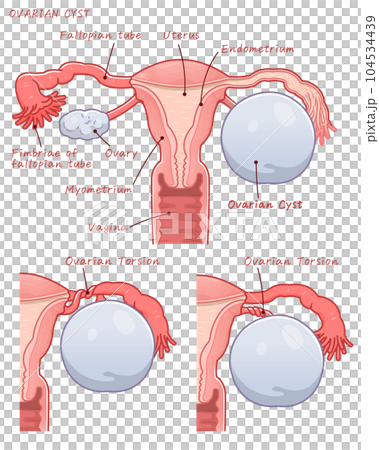 Ovarian cyst, ovarian cyst, stem torsion, Ovarian torsion 104534439