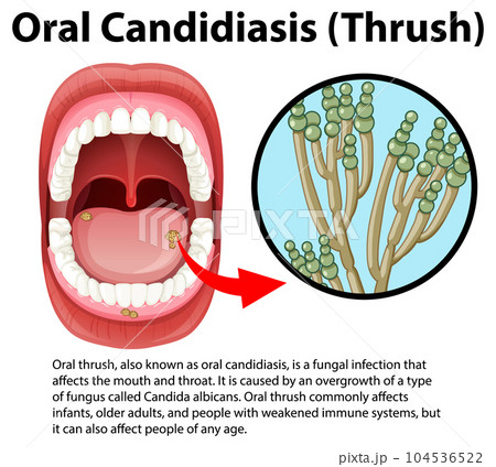 Oral Candidiasis (Thrush) infographic with explanation Oral Candidiasis (Thrush) infographic with explanation 104536522
