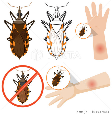 Human arm swollen from kissing bug bite 104537083