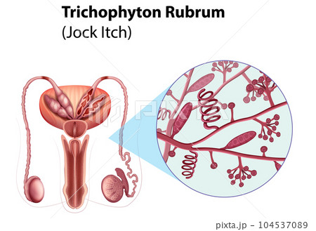 Trichophyton Rubrum fungal infection Trichophyton Rubrum fungal infection 104537089