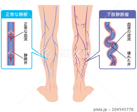 下肢静脈瘤　血管の病気　医療 104545776