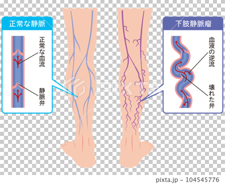 下肢静脈瘤　血管の病気　医療 104545776