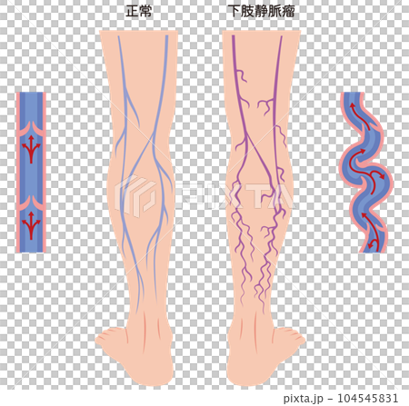 Lower extremity varicose vein disease medical care 104545831