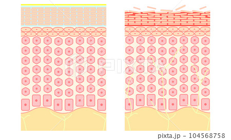 潤い肌と乾燥肌、人間の皮膚の構造 潤い肌と乾燥肌、人間の皮膚の構造 104568758