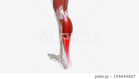 The calf muscles (gastrocnemius) are the most common area of a m 104644887