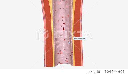 Fat layer accumulating in arteries 104644901