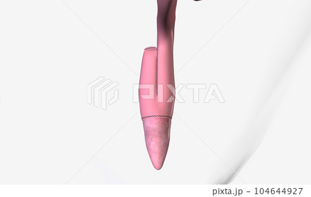 Ileoanal anastomosis surgery allows removal of the upper and low 104644927