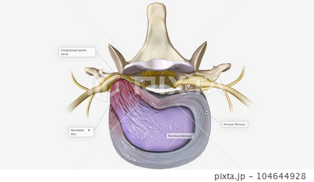 A herniated disc is a condition characterized by structural changes to an intervertebral disc 104644928